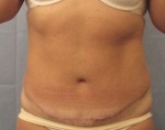 Tummy Tuck