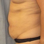 Tummy Tuck