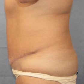 Tummy Tuck