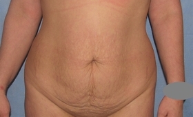 Tummy Tuck