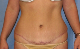 Tummy Tuck