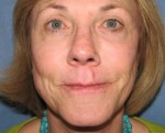 Fraxel Repair Facial Resurfacing