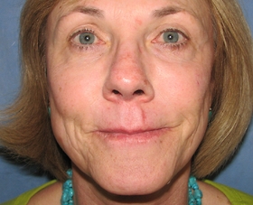 Fraxel Repair Facial Resurfacing