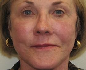 Fraxel Repair Facial Resurfacing