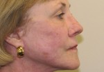 Fraxel Repair Facial Resurfacing