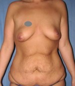 Breast Augmentation