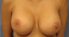 Breast Augmentation