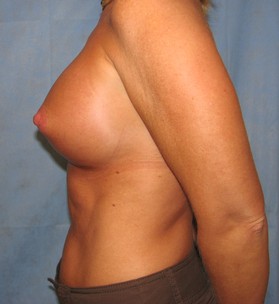 Breast Augmentation