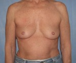 Breast Augmentation