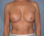 Breast Augmentation