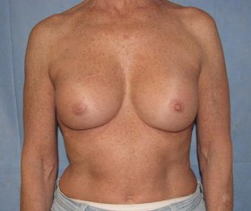 Breast Augmentation