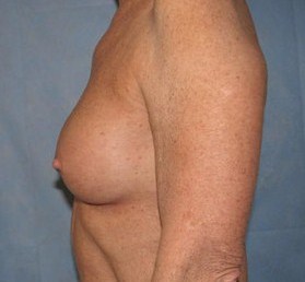 Breast Augmentation