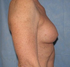 Breast Augmentation