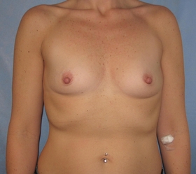 Breast Augmentation