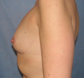 Breast Augmentation