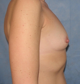 Breast Augmentation