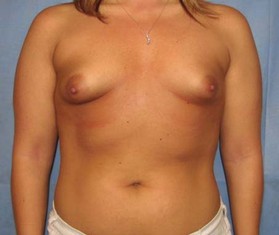 Breast Augmentation