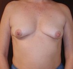 Breast Augmentation