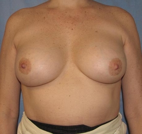 Breast Augmentation