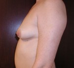 Breast Augmentation