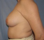 Breast Augmentation