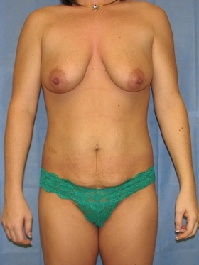 Breast Augmentation with Lift