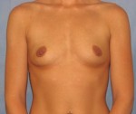 Breast Augmentation