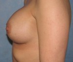 Breast Augmentation