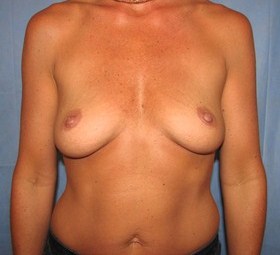 Breast Augmentation