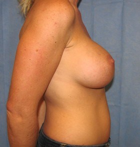 Breast Augmentation