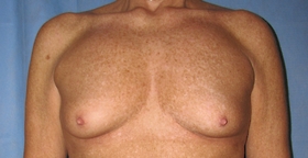 Breast Augmentation