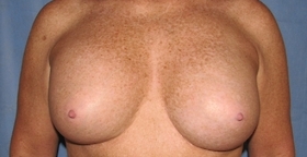 Breast Augmentation