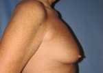 Breast Augmentation