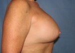 Breast Augmentation