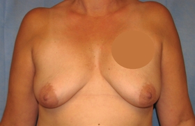 Breast Augmentation