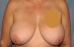 Breast Augmentation