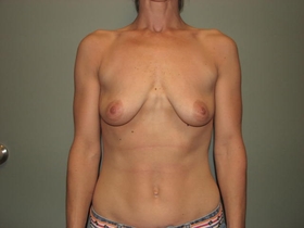 Breast Augmentation