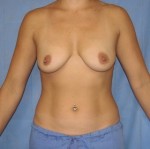 Breast Augmentation