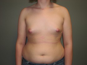 Breast Augmentation