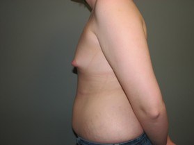 Breast Augmentation