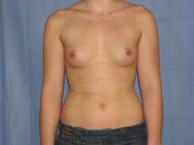 Breast Augmentation