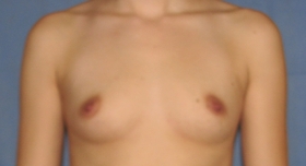 Breast Augmentation