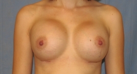 Breast Augmentation