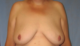 Breast Augmentation with Lift