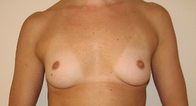 Breast Augmentation