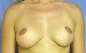 Breast Augmentation