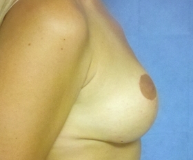 Breast Augmentation