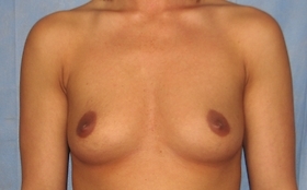 Breast Augmentation