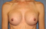 Breast Augmentation