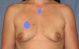 Breast Augmentation